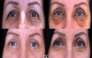 Blepharoplasty or Eyelid Surgery